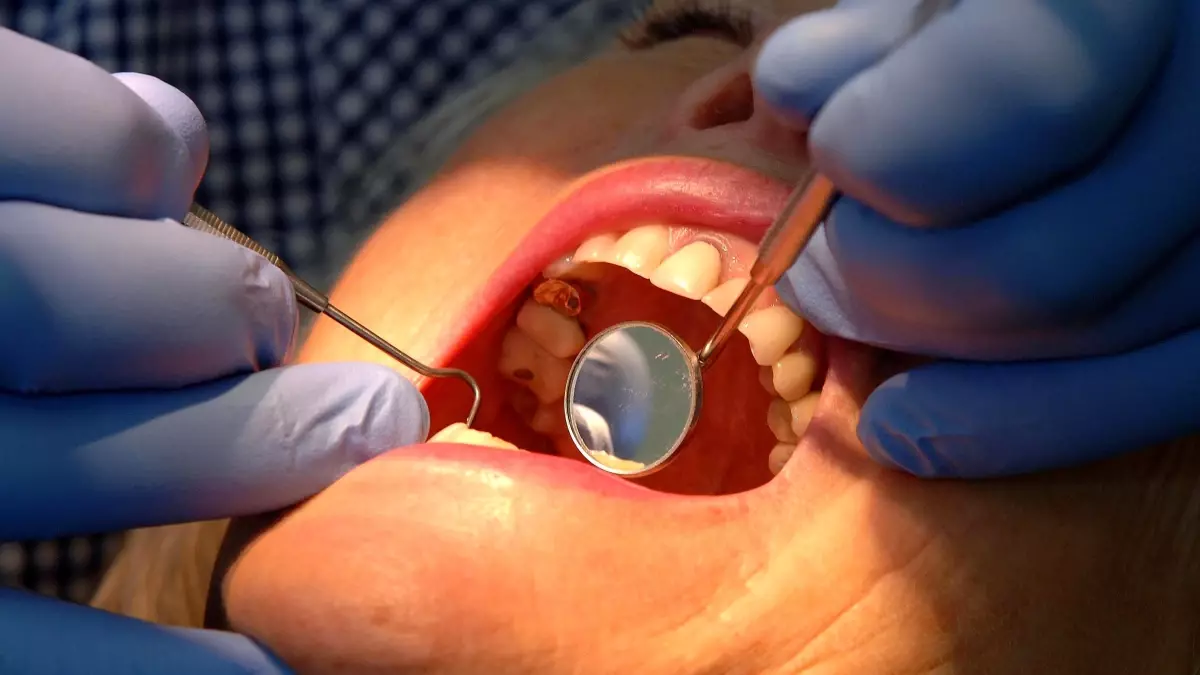 Diş Minesi İçin Yenilikçi Jel Geliştirildi