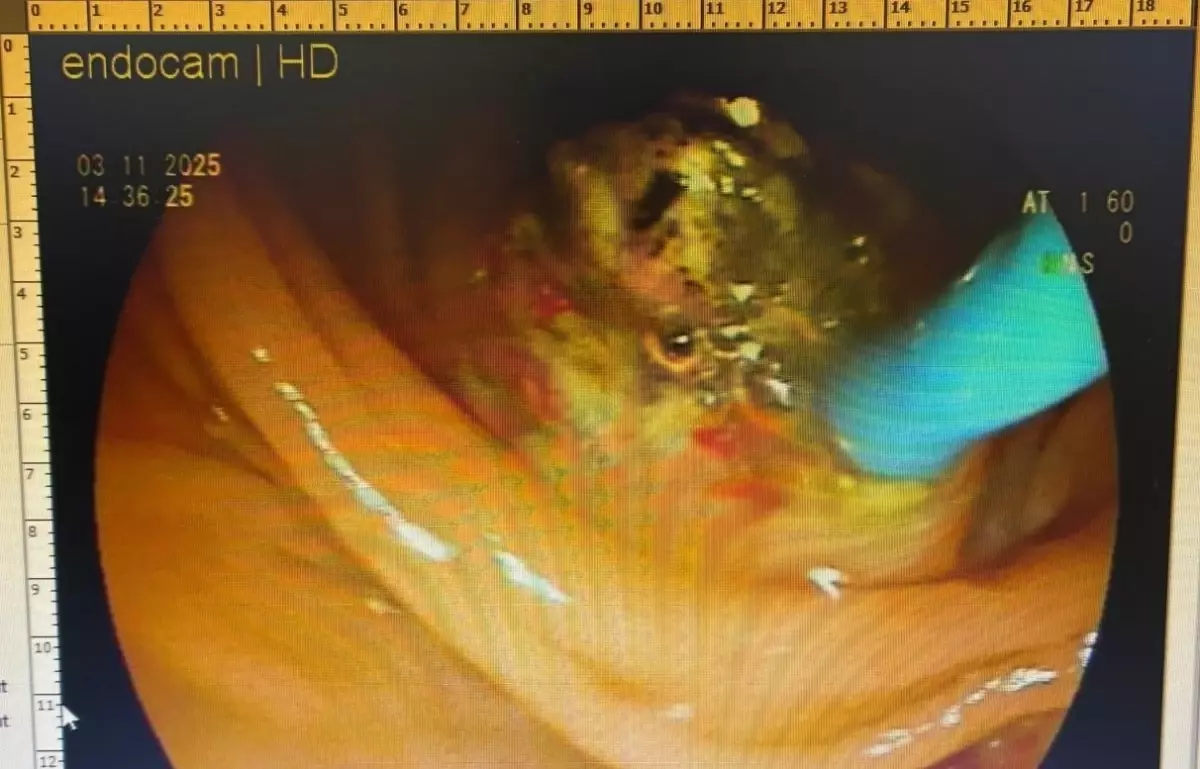 Nadir Durum: Kadının İç Organları Ters Düzenlendi