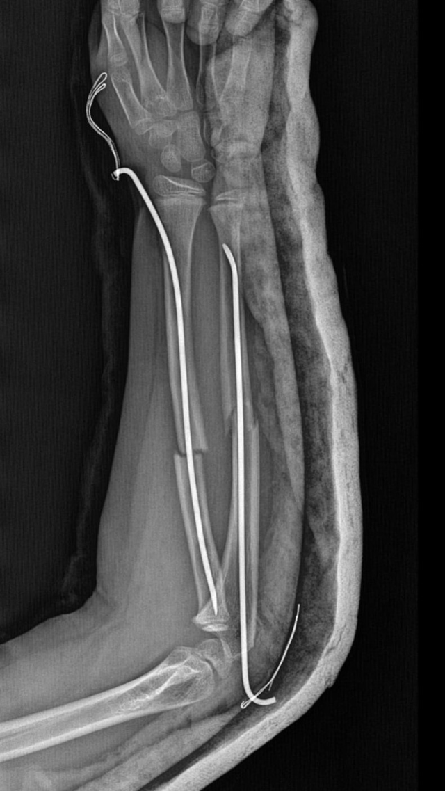 9 yaşındaki çocuk, 8 yaşındaki çocuğun kolunu kırarak intikam aldı 9 yaşındaki çocuk, 8 yaşındaki çocuğun kolunu kırarak intikam aldı
