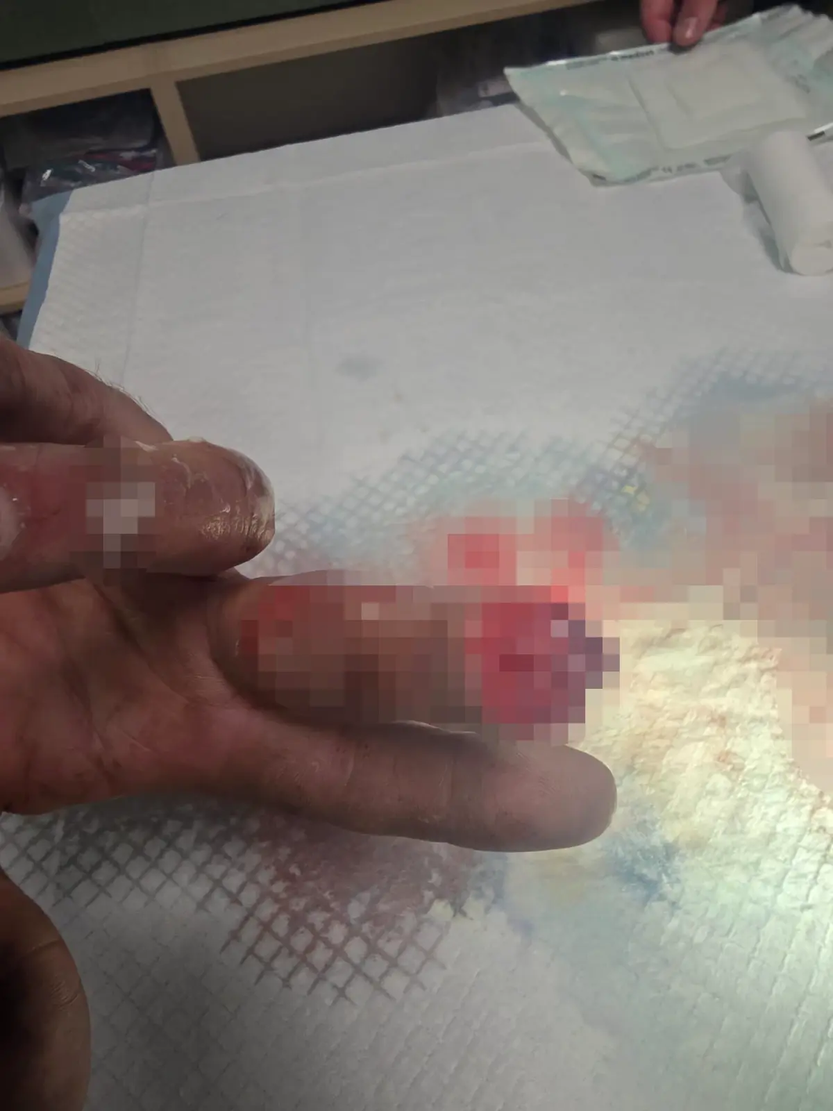 Kopan parmağını buz poşetine koyup yurt dışından Türkiye'ye geldi