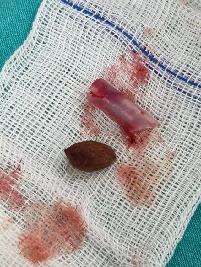 Kaşıntı şikayetiyle gitti, burnundan çıkanlar akıl alır gibi değil