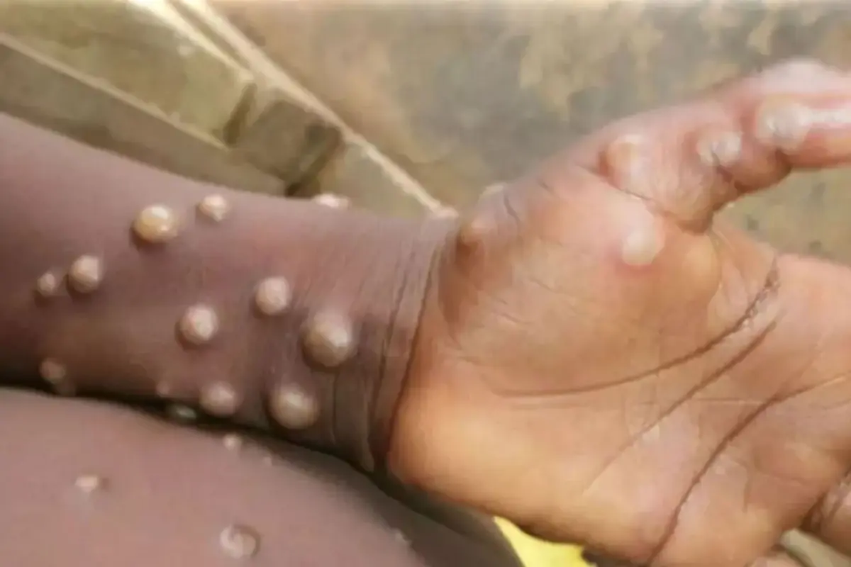 Madagaskar'da İlk Mpox Vakaları Tespit Edildi