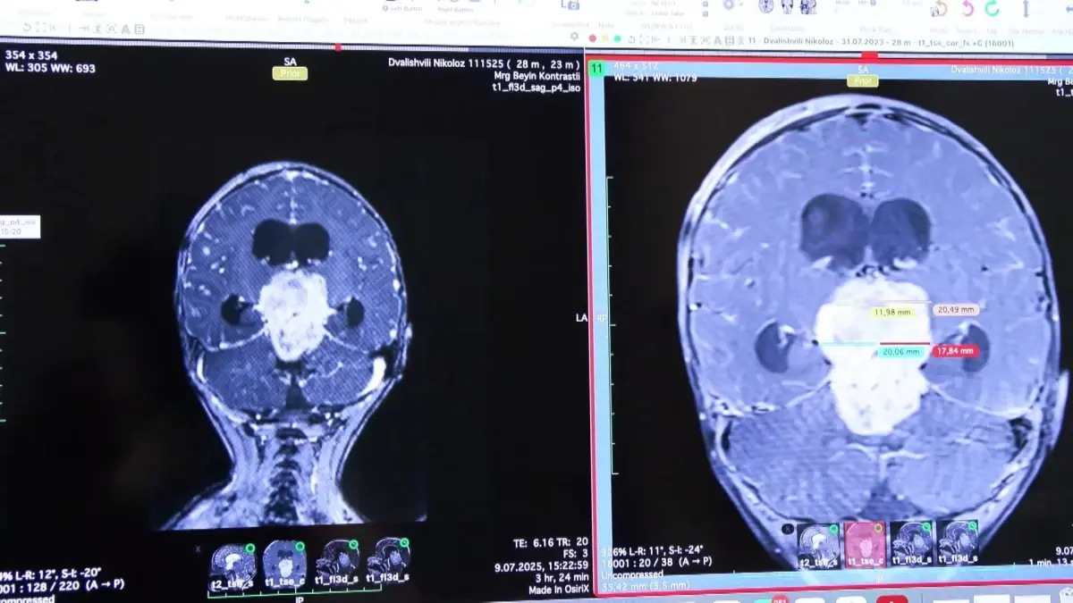 2.5 Yaşındaki Nikoloz\'un Tümör Ameliyatı Başarıyla Gerçekleşti