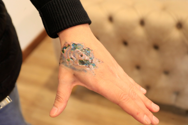 Dövme sildirmek isterken kabusu yaşadı, elindeki dokular öldü