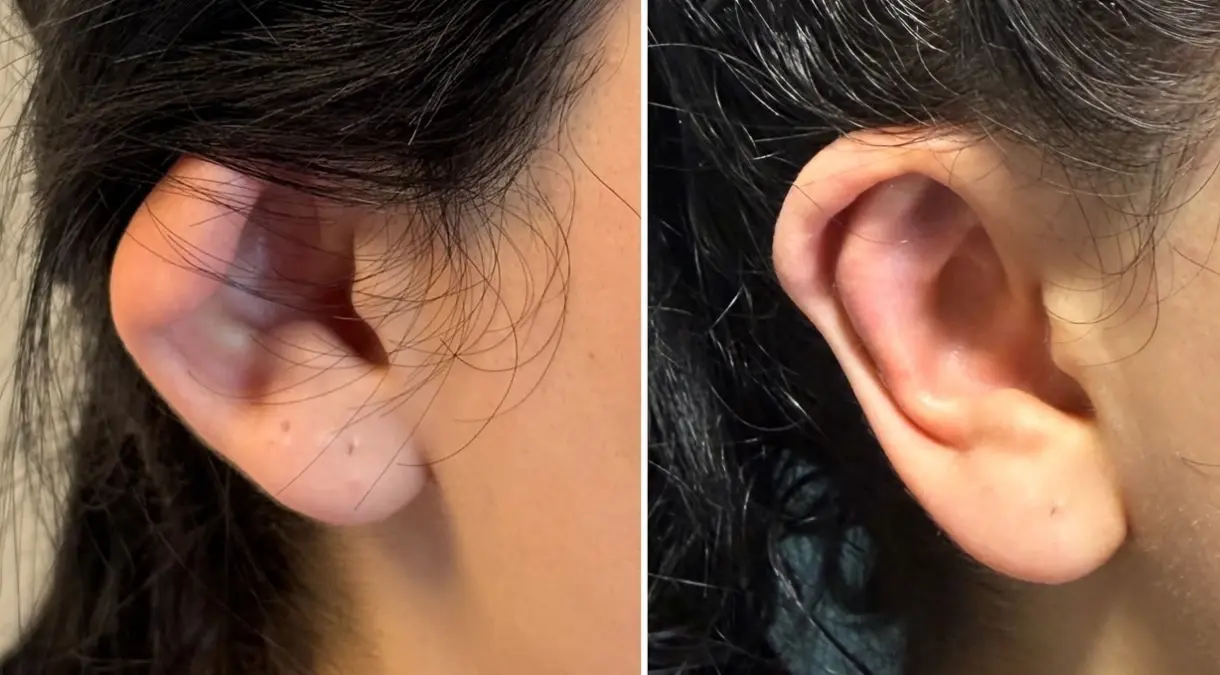 Kepçe Kulak Ameliyatı Özgüveni Artırıyor