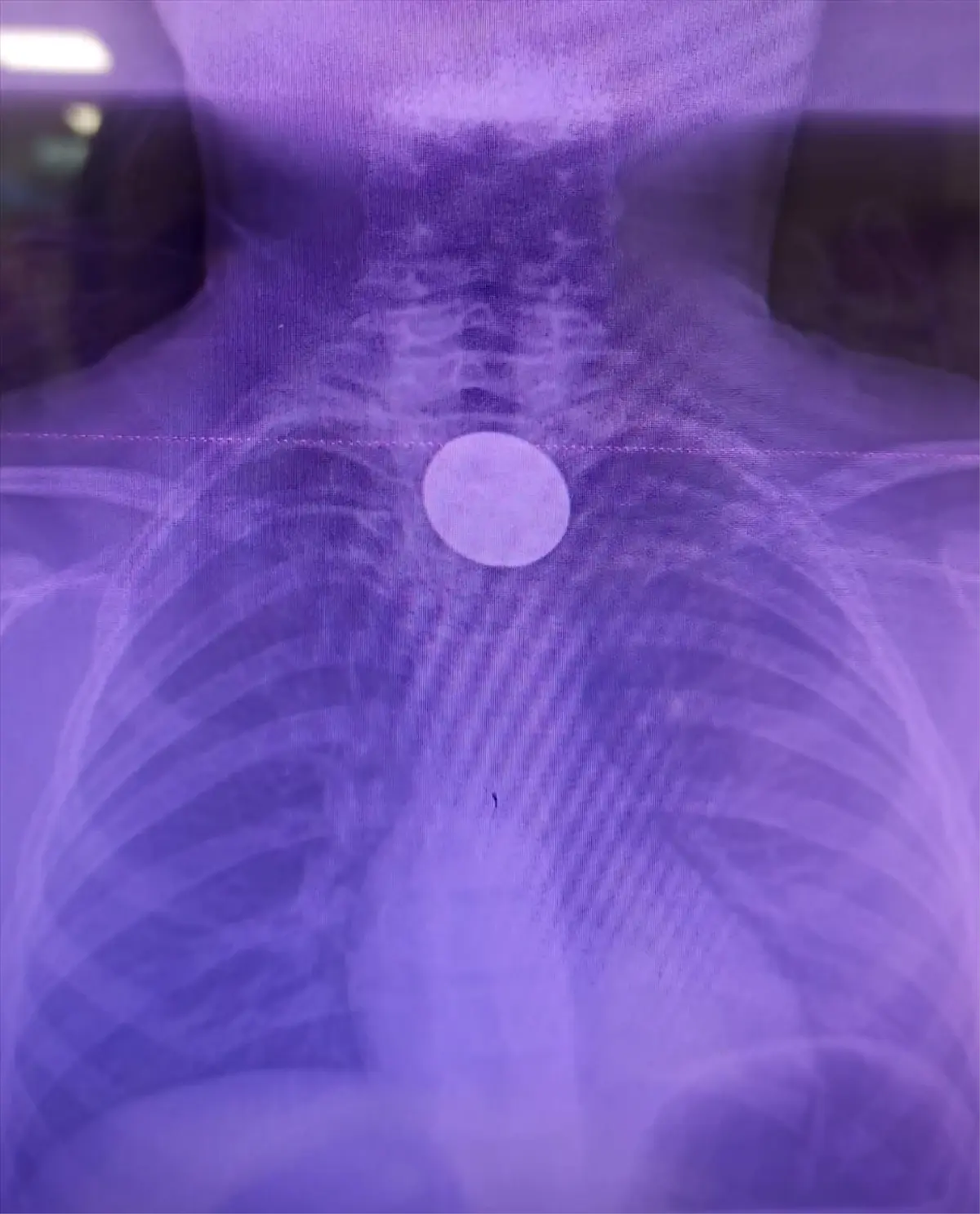 Siirt\'te 8 Yaşındaki Çocuk Parayı Yuttu