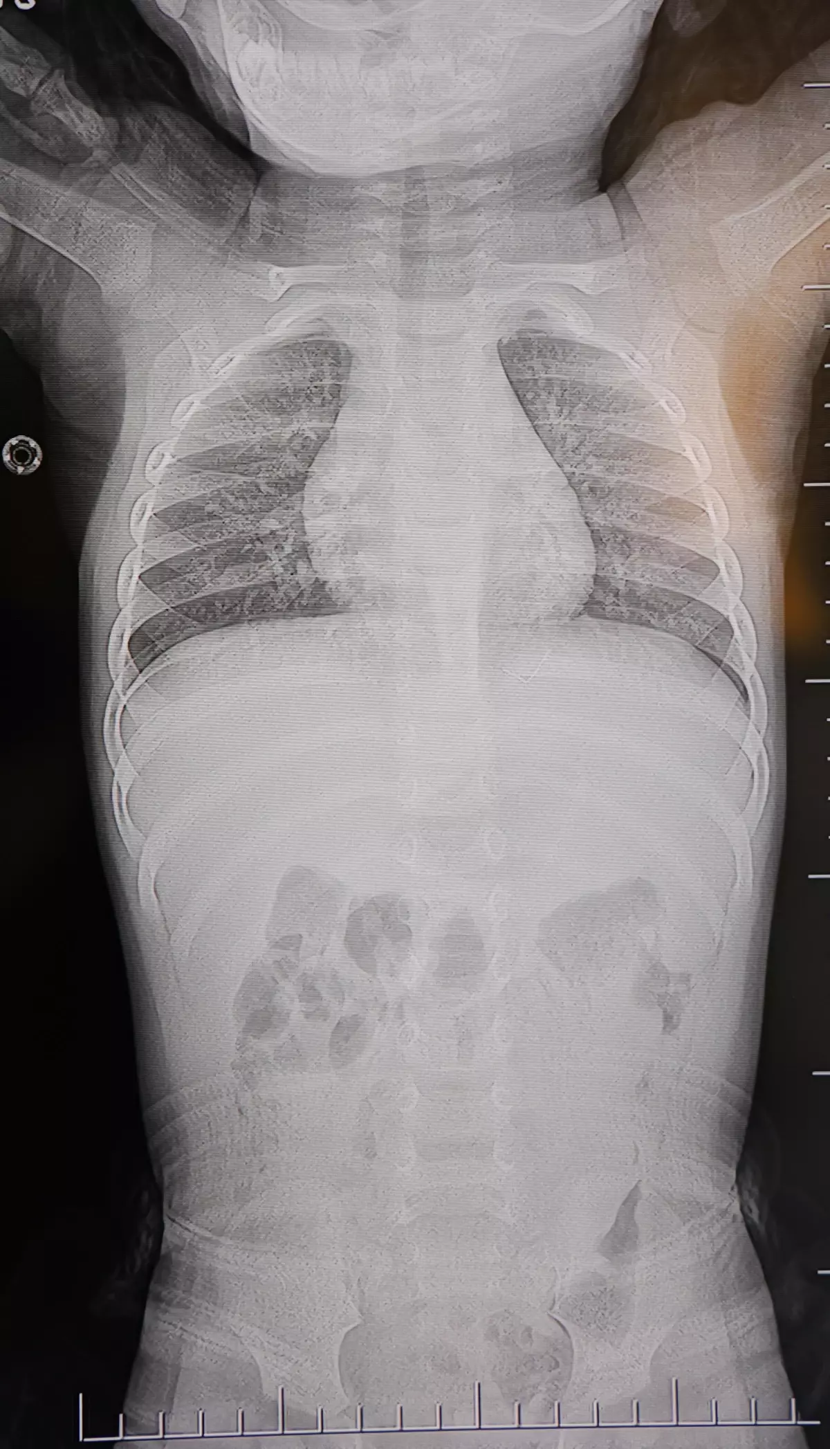 1 yaşındaki bebek sırtüstü yatırılınca hep ağladı! Gerçeği öğrenen aile şoke oldu