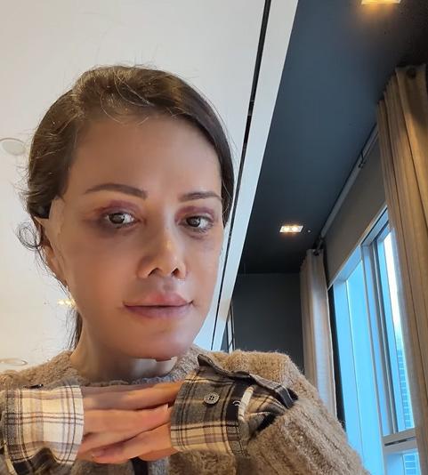 Eski Survivor yarışmacısı Didem Ceran yüz nakli oldu! Son haline yorum yağıyor