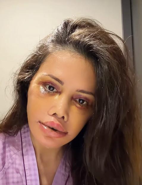 Eski Survivor yarışmacısı Didem Ceran yüz nakli oldu! Son haline yorum yağıyor