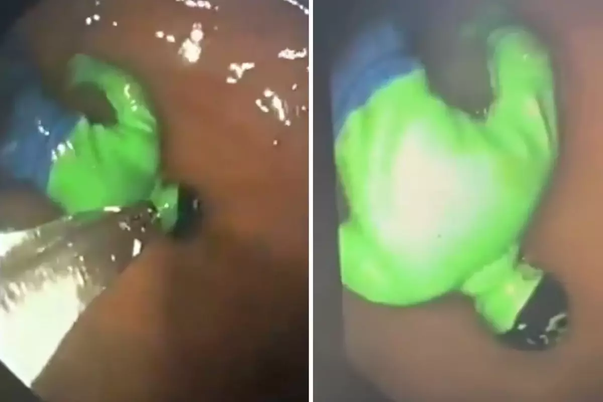 Hindistan\'da çocuğun midesinden "hulk" çıktı