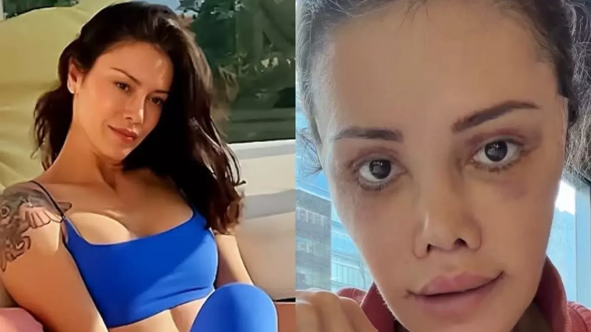 Yüz nakli yaptıran Didem Ceran\'ın son hali: Harika gözüküyorum