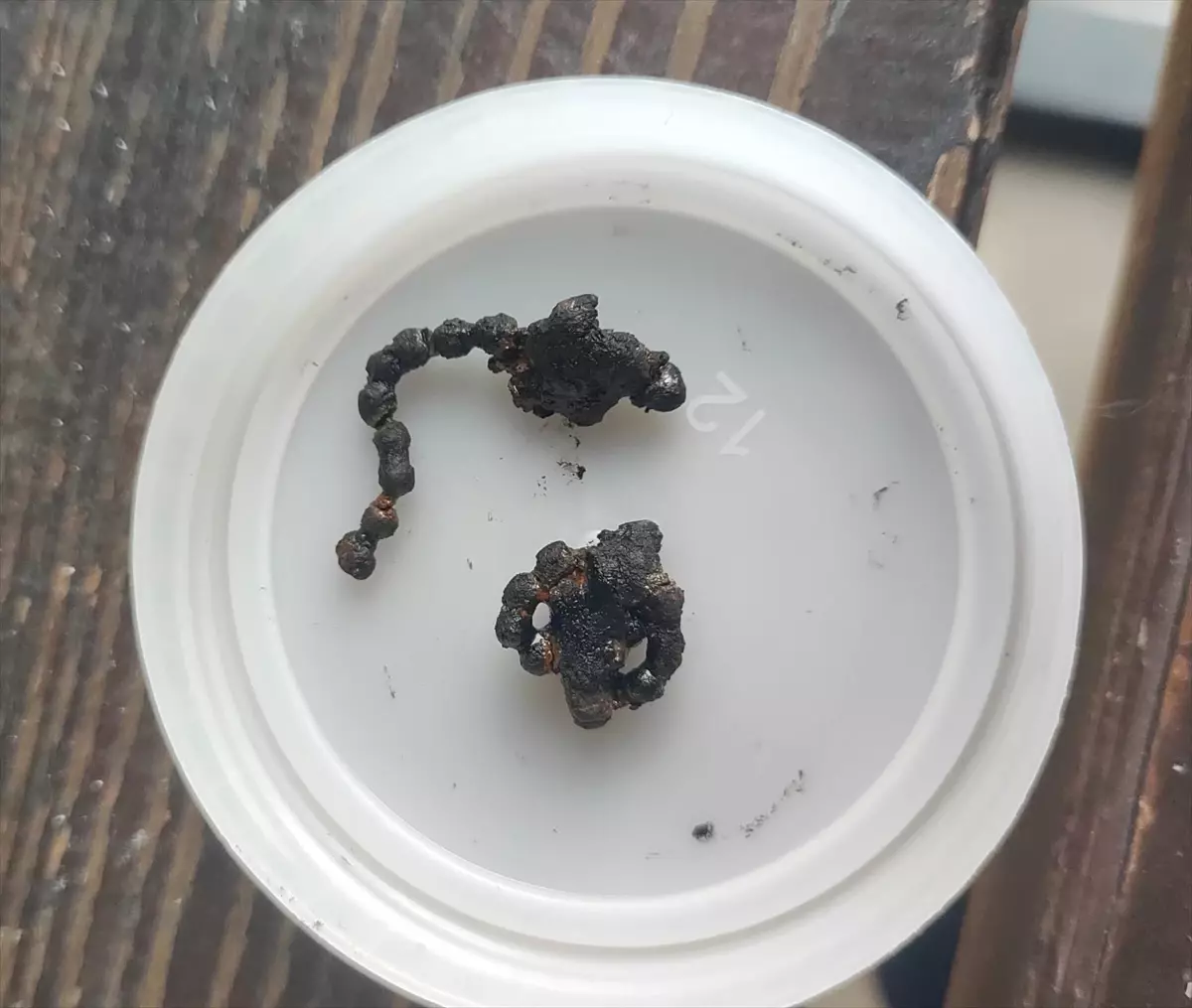 Rize\'de 5 Yaşındaki Çocuğun Burnundaki Metal Zincir Çıkarıldı