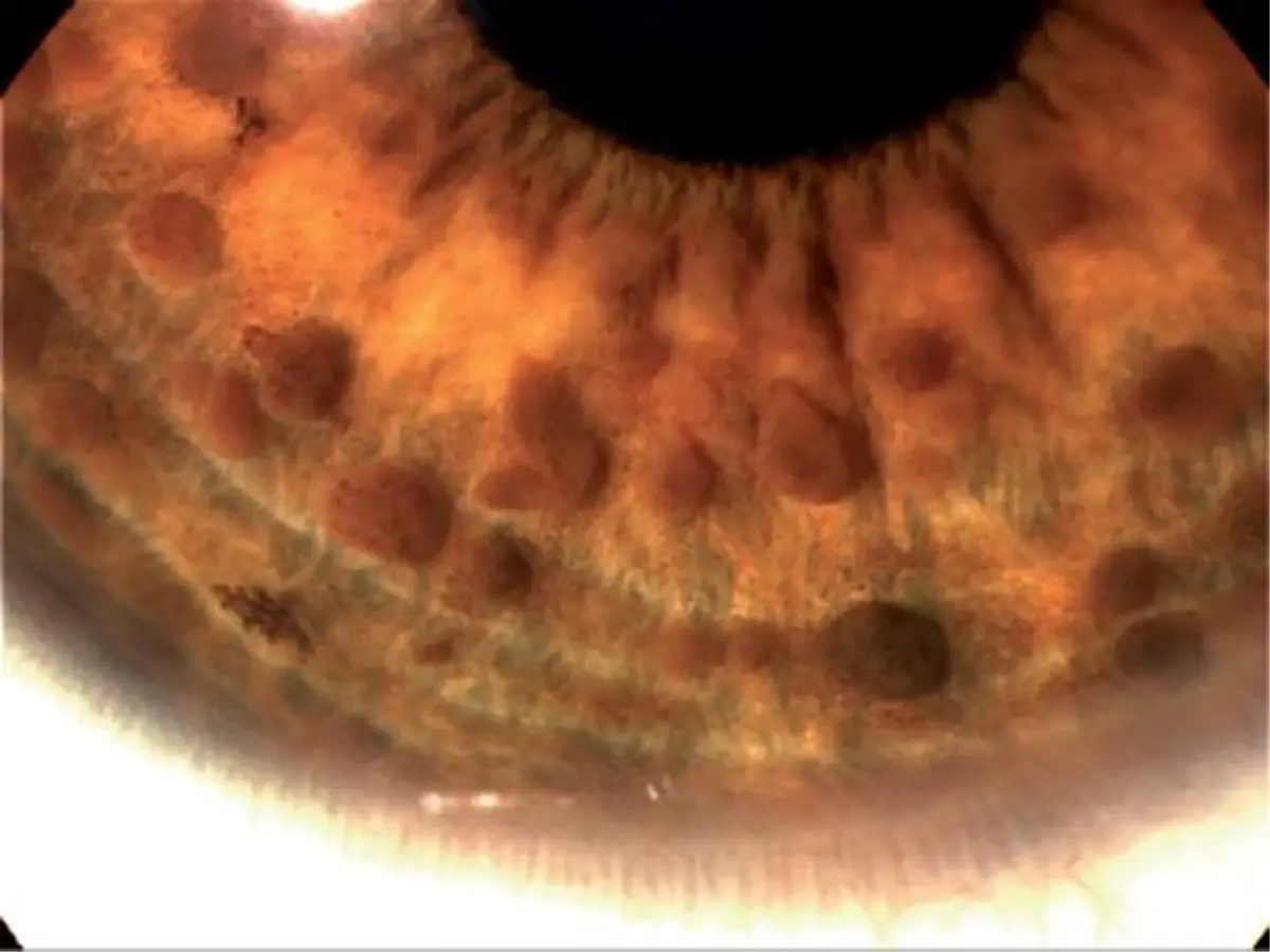 Nörofibromatozis Tip 1 Tanısı OCT ile Daha Kolay ve Başarılı