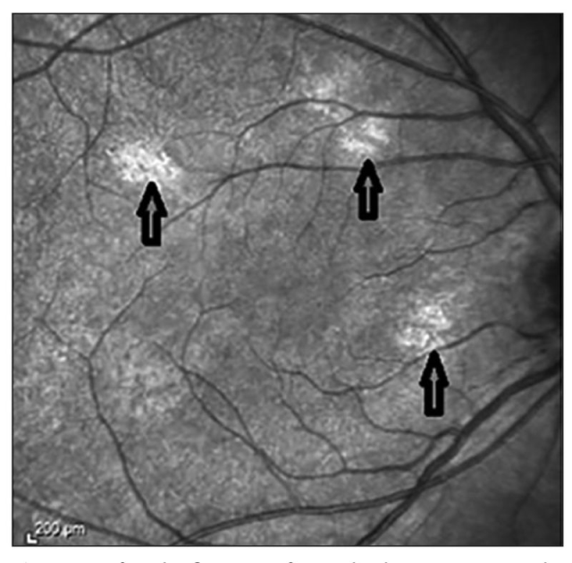Nörofibromatozis Tip 1 Tanısı OCT ile Daha Kolay ve Başarılı Nörofibromatozis Tip 1 Tanısı OCT ile Daha Kolay ve Başarılı