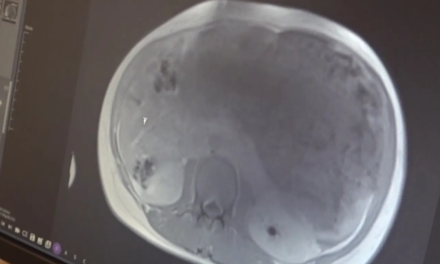 Kazakistanlı kadının karnından yaklaşık 45 santimetrelik tümör çıkarıldı