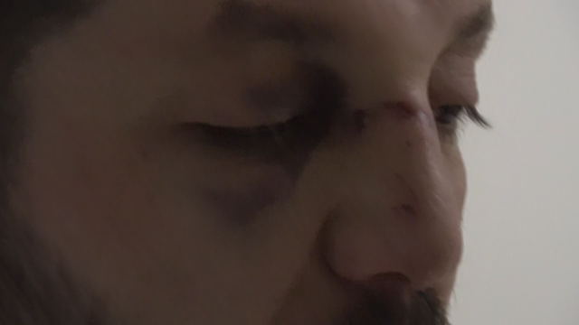 Komşuların gürültü kavgasında 14 aylık bebeğin kafatası çatladı