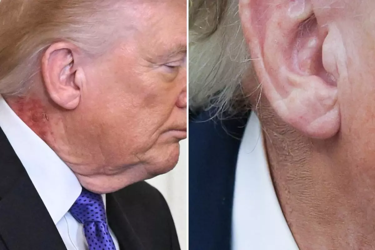 Trump\'ın boynundaki kızarıklığı gizleme çabası