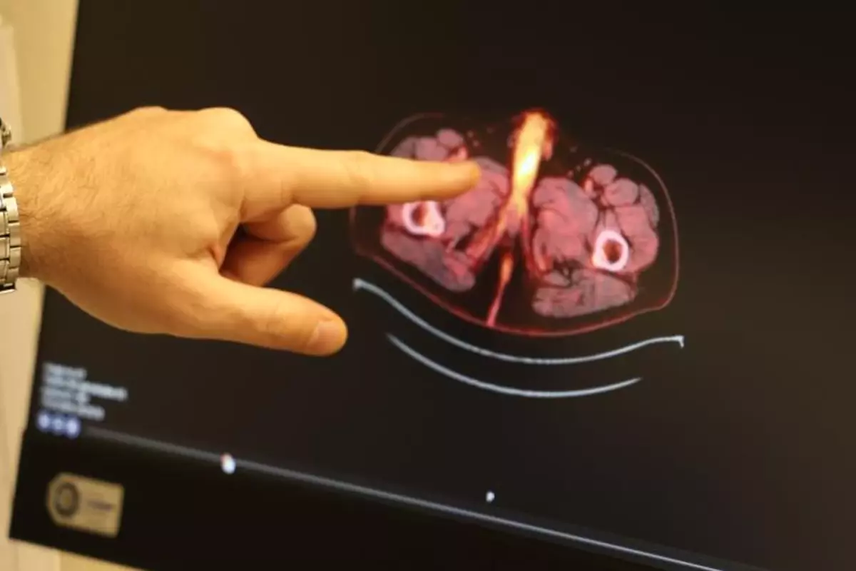 Tıp literatürüne giren son isim Diyarbakır\'dan! Penisi alındı