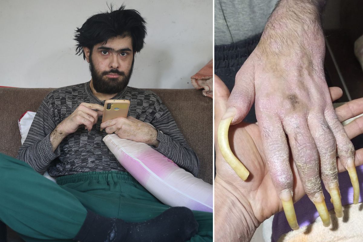 Türkiye\'nin konuştuğu Barış\'ın son hali! 25 yaşını kutladı, türkü bile söyledi