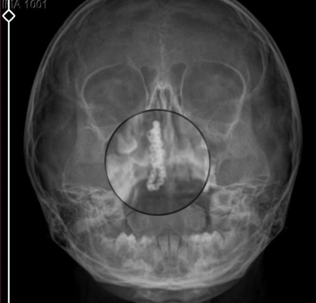 5 yaşındaki Polen yıllarca böyle yaşamış! Burnundan ameliyatla çıkardılar