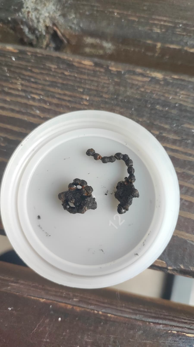 5 yaşındaki Polen yıllarca böyle yaşamış! Burnundan ameliyatla çıkardılar