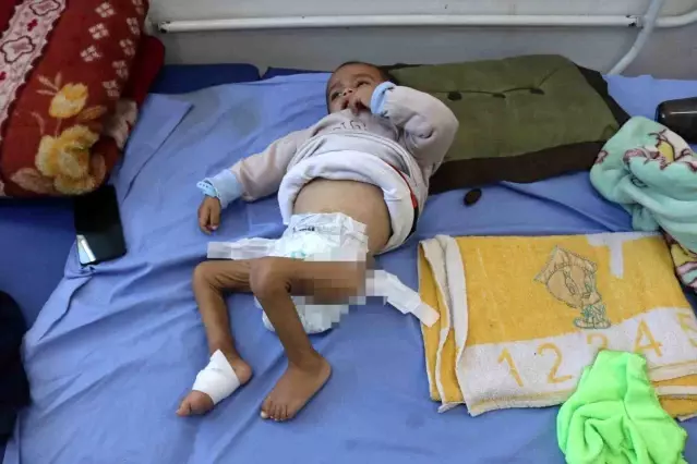 Gazze’de Çocuklar Yetersiz Beslenmeyle Mücadele Ediyor