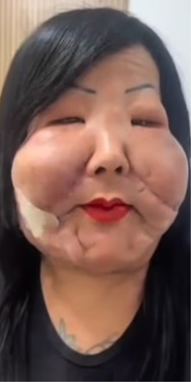 Güzellik uğruna yüzü tanınmaz hale geldi! Yine akıllanmadı