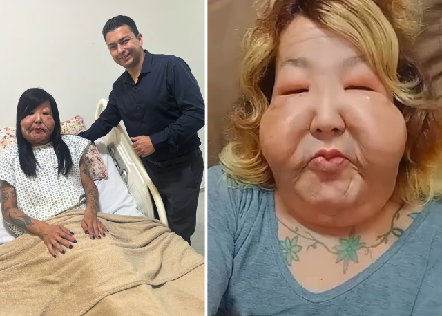 Güzellik uğruna yüzü tanınmaz hale geldi! Yine akıllanmadı