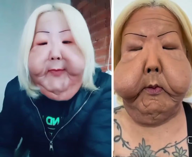 Güzellik uğruna yüzü tanınmaz hale geldi! Yine akıllanmadı