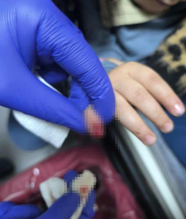 AVM'de yürüyen merdivene eli sıkışan çocuğun parmağı koptu