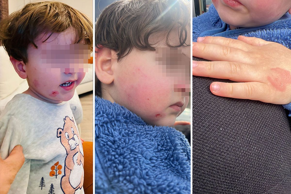 Kreşe bıraktığı çocuğunu darp edilmiş halde aldı