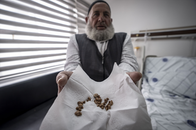 İdrar kanalından çıkan 51 taş, doktorları bile şaşkına çevirdi