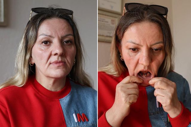 Diş ağrısı şikayetiyle gitti, 25 dişinden oldu