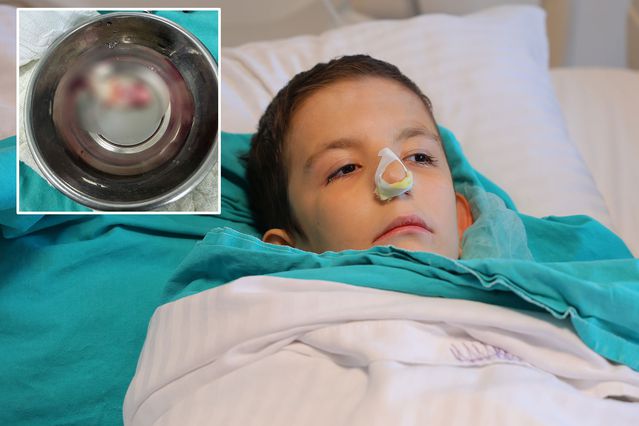 Burun tıkanıklığı şikayetiyle hastaneye gitti, ağzından dev bir polip çıkartıldı