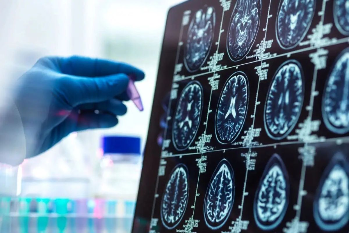 Alzheimer\'in Belirtileri Öncesi İlerlemesi Keşfedildi
