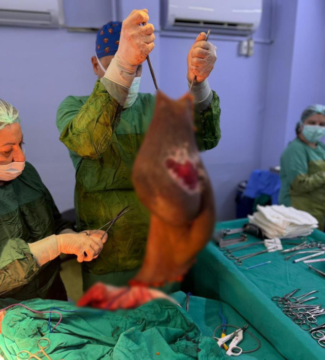 Bu kitle bir insanın karnından çıktı! Doktor tek başına kaldıramadı