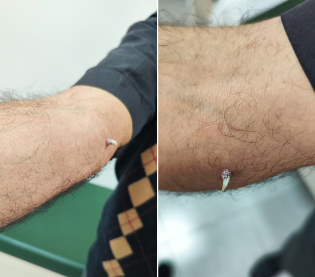 Kolundaki 1 santimetrelik yara kanser çıktı