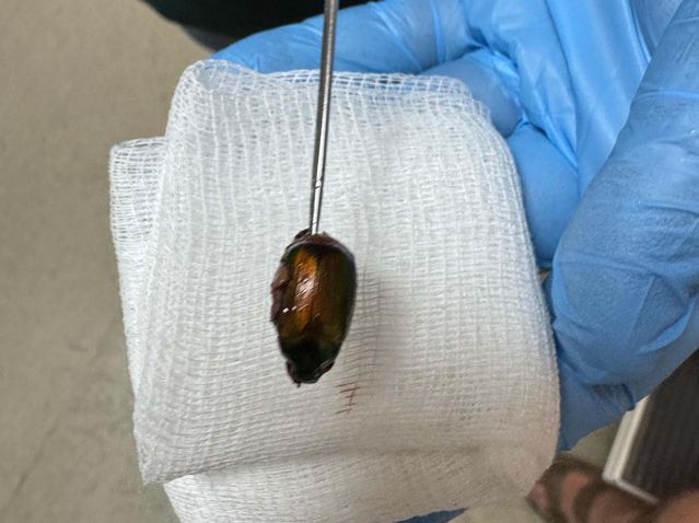 Kulağındaki ağrının nedeni şaşkına çevirdi! Doktorlar Japon böceği çıkardı