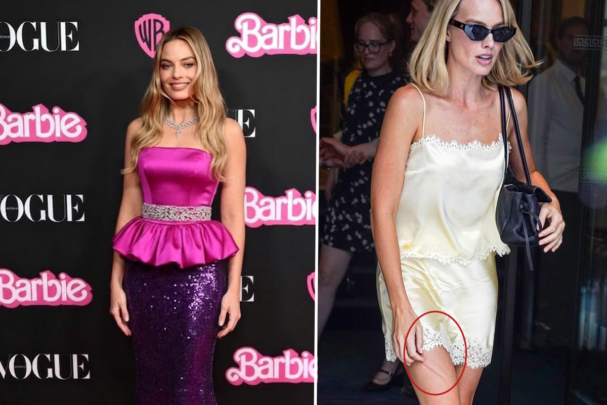 Barbie yıldızı Margot Robbie\'nin bacağındaki morluk hayranlarını endişelendirdi