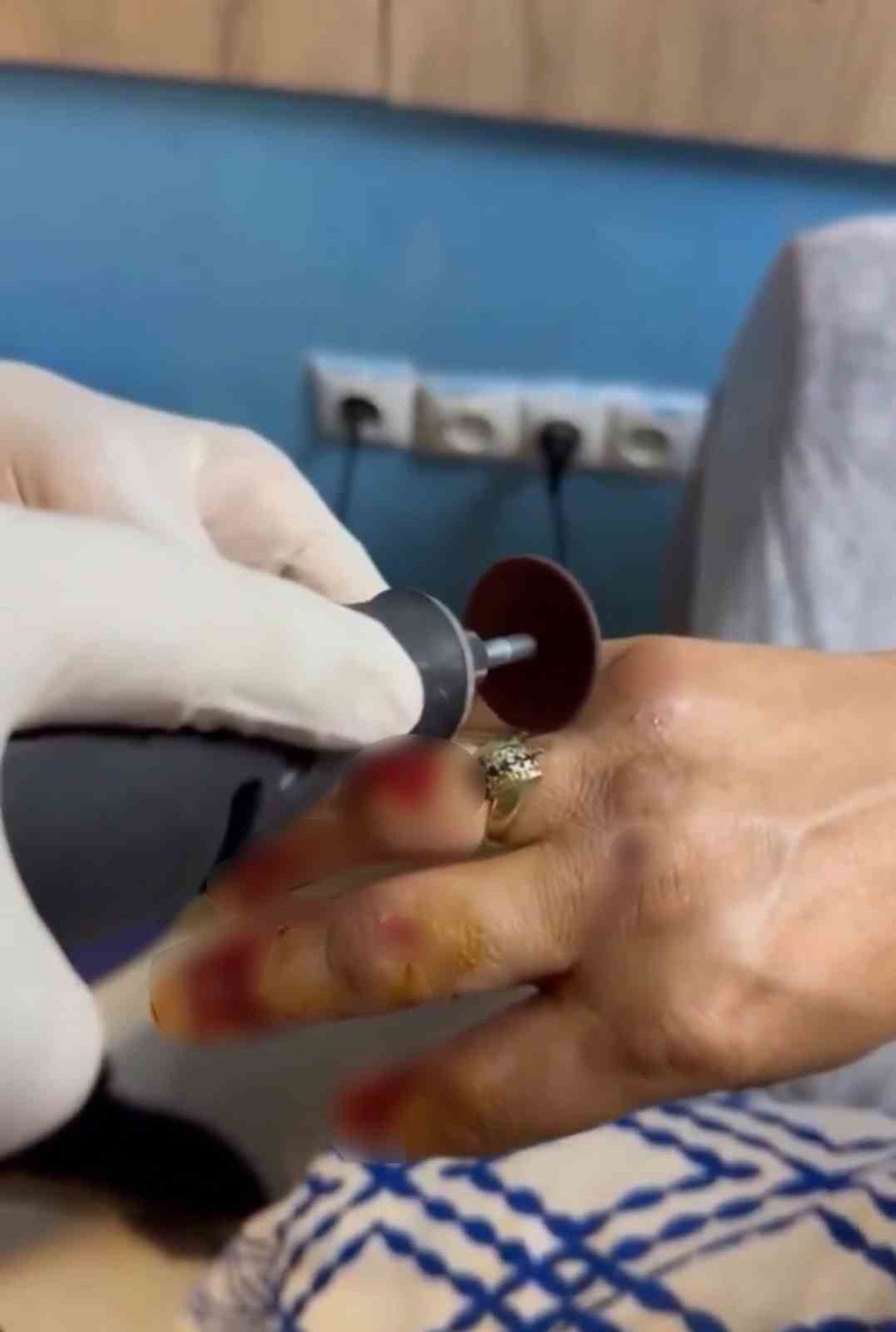 Yüzük, İtfaiye Ekipleri Tarafından Kesilerek Çıkarıldı