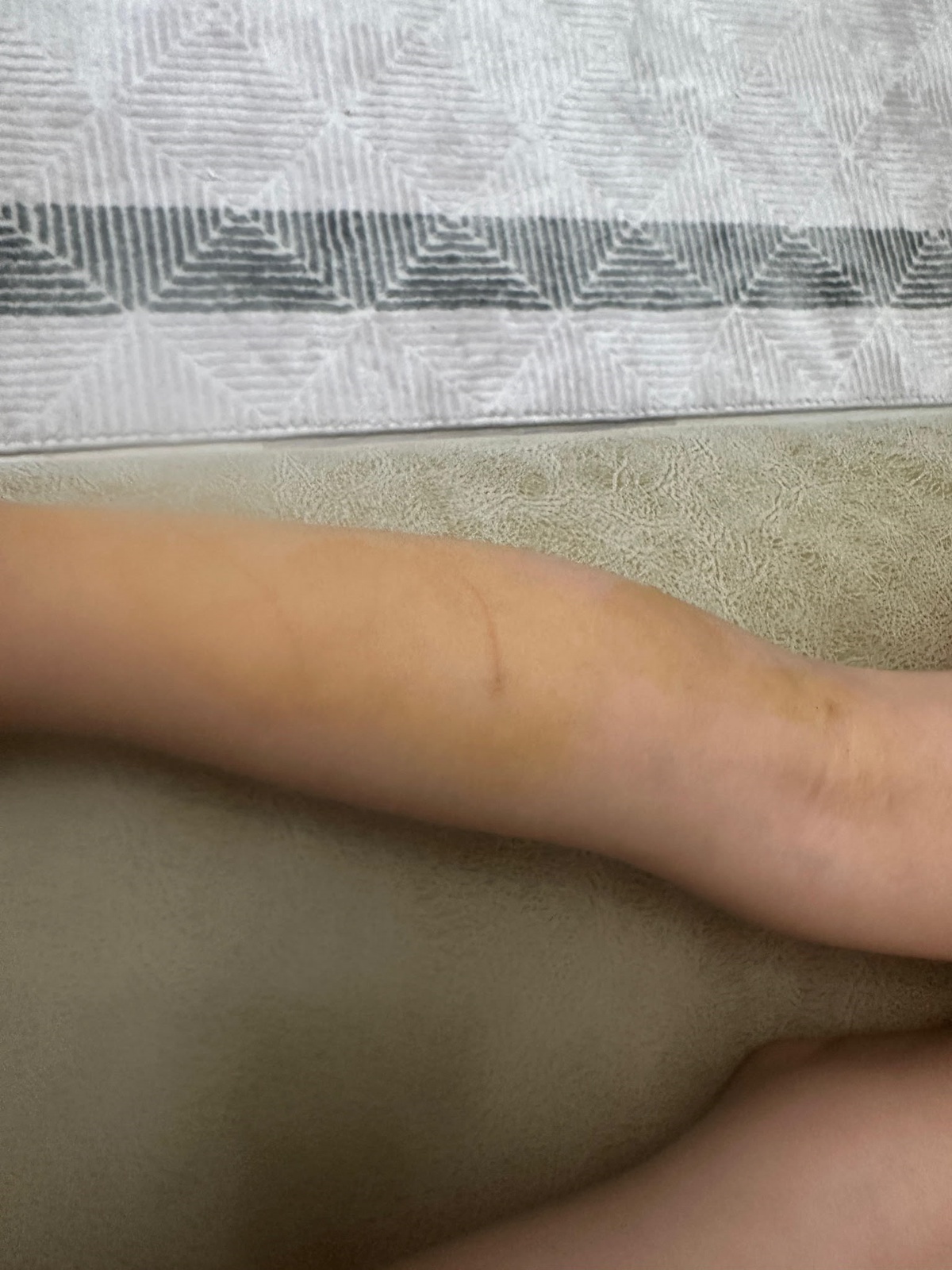 3 Yaşındaki Kız Sokak Köpeğinin Saldırısına Uğradı