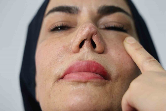 Burun estetiği faciayla sonuçlandı: Kadının hayatı kabusa döndü