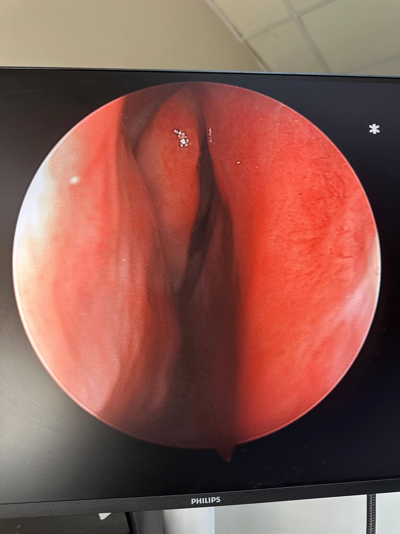 Silopi'de İlk Septal Perforasyon Ameliyatı
