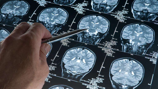 Derin Uyku Beyin Dalgaları Alzheimer'ın İlerleyişini Yavaşlatabilir