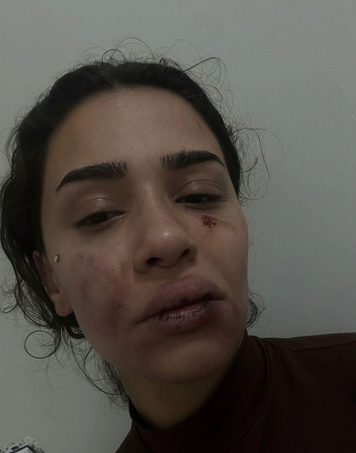Hemşire Ebru Anik: Uzaklaştırma Kararına Rağmen Eski Sevgili Şiddeti