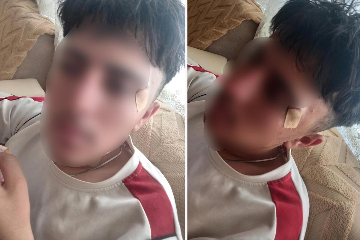 İddia vahim! Öğretmenin kafa attığı çocuğun burnu kırıldı