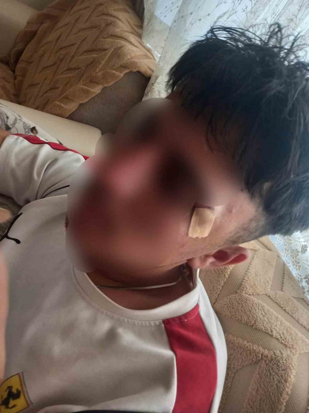 Afyonkarahisar'da öğretmenin kafa attığı iddia edilen çocuğun burnu kırıldı