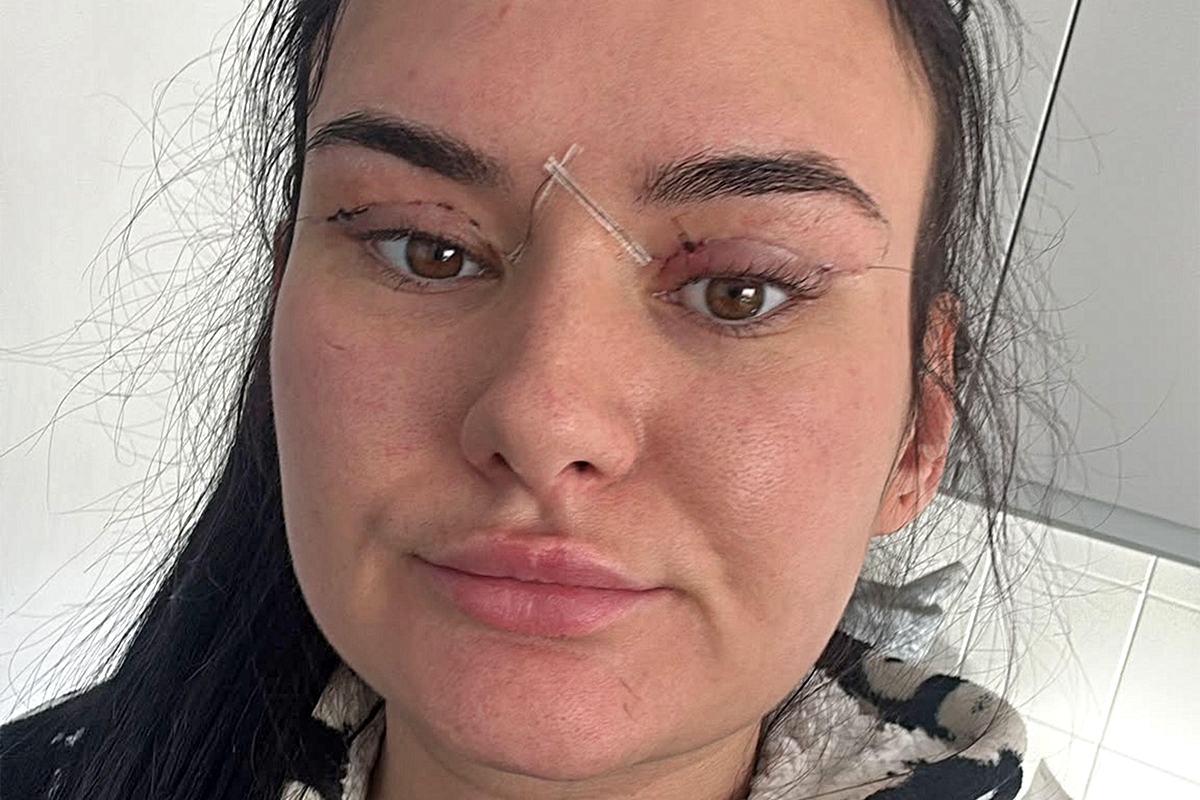 Göz kapağı ameliyatı için yurt dışına gittiler, acil servise düştüler