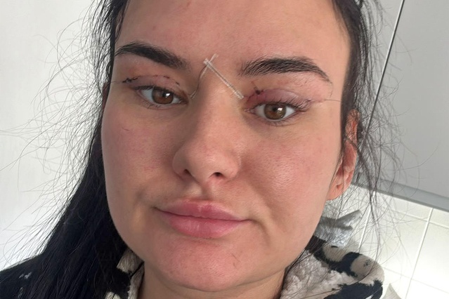 Ucuz blefaroplasti için yurtdışına gidenlerde komplikasyonlar NHS'yi zorluyor