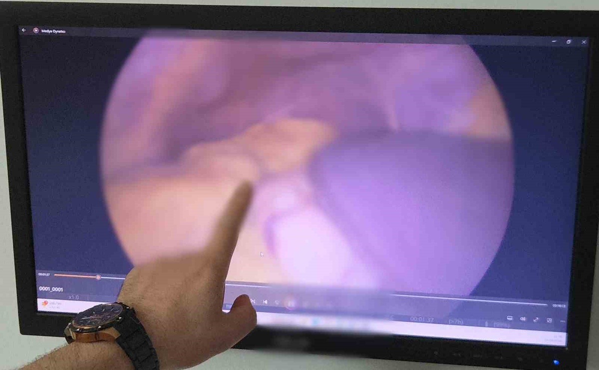 Kalbi sağda olan inşaat işçisinin diğer organları da ters çıktı: Samsun\'da zorlu ameliyat
